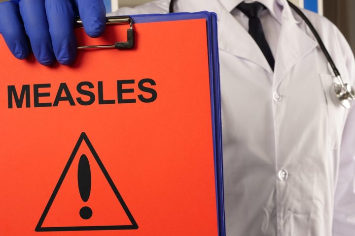 santa-barbara-confirms-measles-case